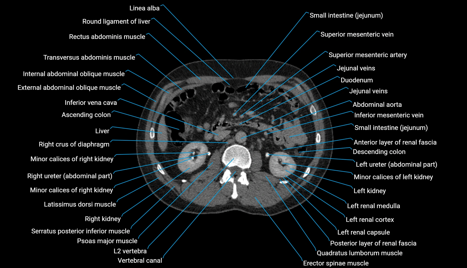 CT urogram axial cross sectional anatomy  labelled radiology image-00110.webp